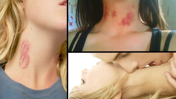 Getting A Hickey Can Cause A Stroke, So Maybe Stop Sucking On Each Other’s ...